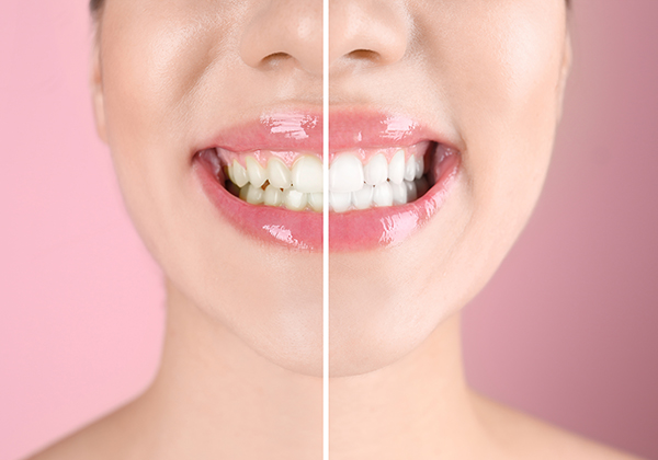 Ringiovanisci i tuoi denti con un trattamento antiaging in omaggio con la seduta d’igiene